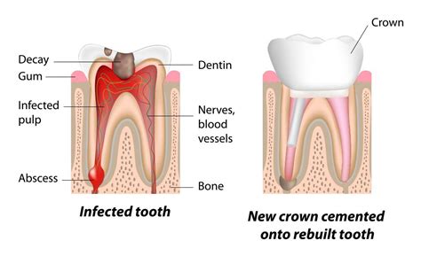 Root Canal Barre, MA – Robert Rapisarda DMD