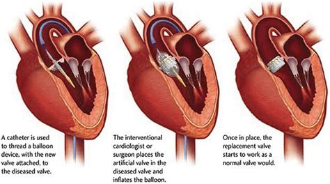 Transcatheter Aortic Valve Replacement Market May See a Big Move ...