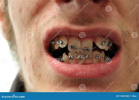 Crooked Teeth Before Braces Royalty-Free Stock Photography | CartoonDealer.com #49482533