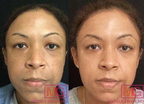 Microneedling PRP, Platelet Rich Plasma with Microneedling