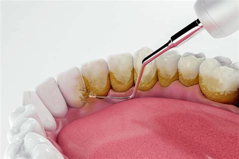 Dental Scaling and Polishing: Reliable & Caring Dentists