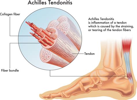 Physio for Archilles Tendonitis - Toronto | Vaughan | Simply Align Rehab