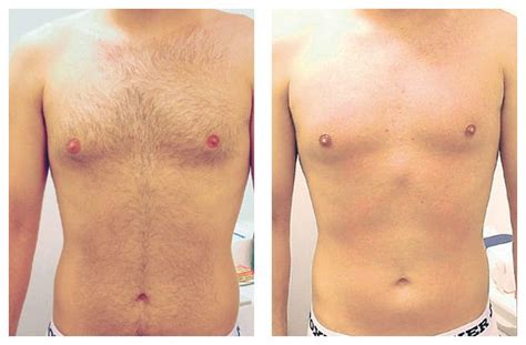 Hair removal of the chest Photo courtesy of Candela #AlexAlexa #Medispa ...