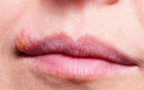 Pimple on Lip: Causes, Treatment, and Prevention