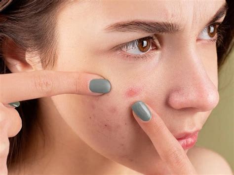 Acne & Scars (pimples/cysts) - Medical Spa Club