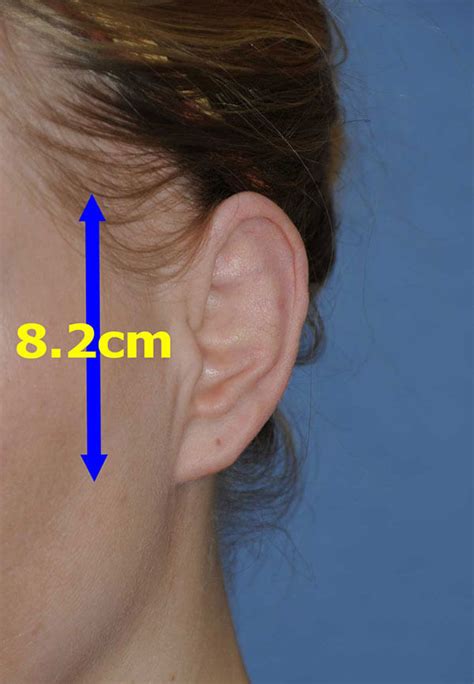 Macrotia Large Ear Reduction Prominent Ear Pinning Otoplasty