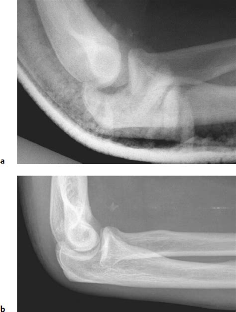 Elbow Trauma | Radiology Key