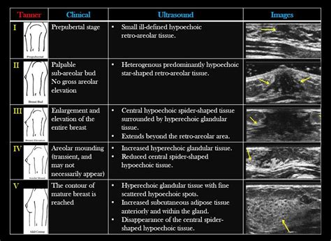 Tanner scale of puberty | Radiology imaging, Medical ultrasound, Breast ultrasound