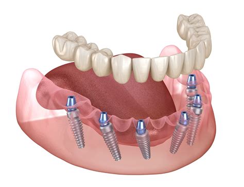 Understanding The All On 4 Procedure: Step-By-Step Breakdown - Giornalisti Anticamorra