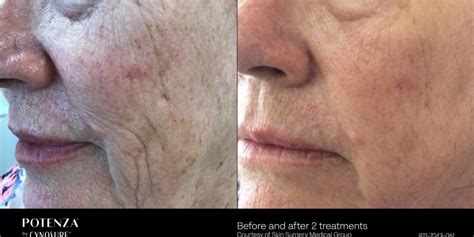 RF Microneedling Before and After | Potenza RF Microneedling