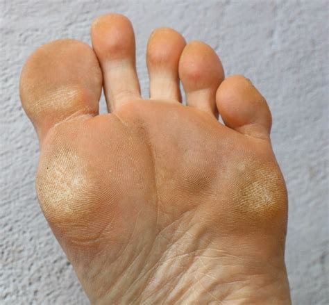 Plantar Warts