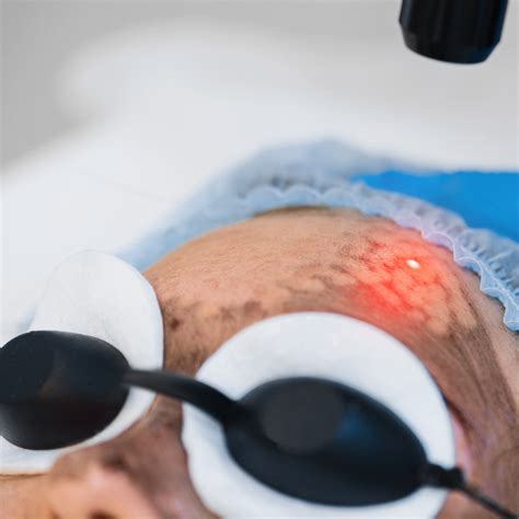 Laser Skin Lightening Treatment I Answers by Top Dermatologist in Bangalore