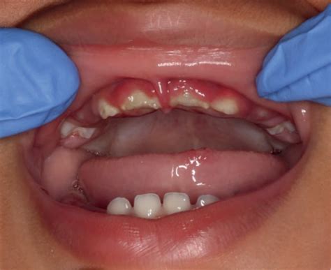 Table 1 from Primary herpetic gingivostomatitis in children | Semantic Scholar