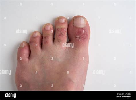 Dermatitis On Feet