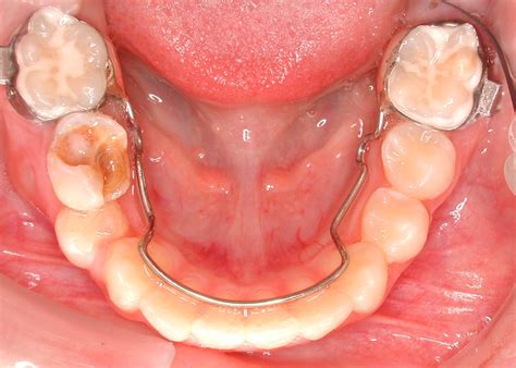 Rate Of Orthodontic Tooth Movement