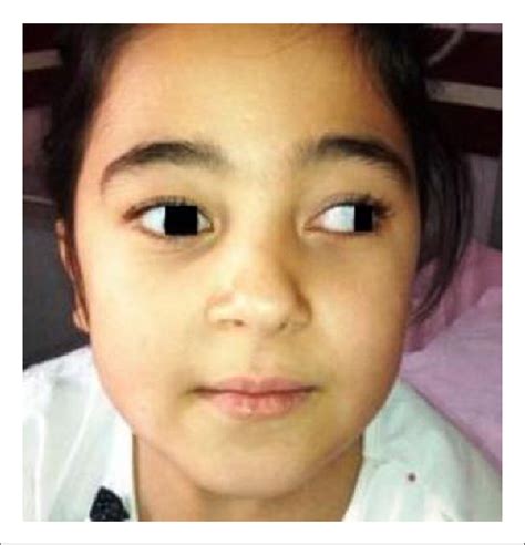 Decreased limitation of abduction and adduction on the right eye after...