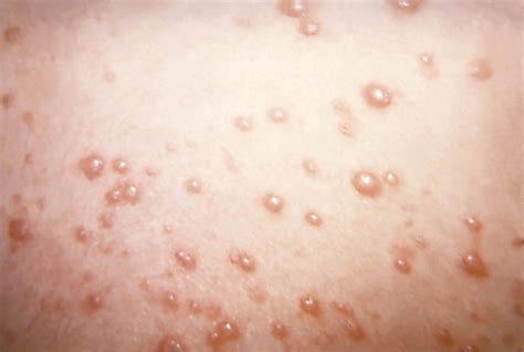 Chickenpox: Symptoms and Pictures