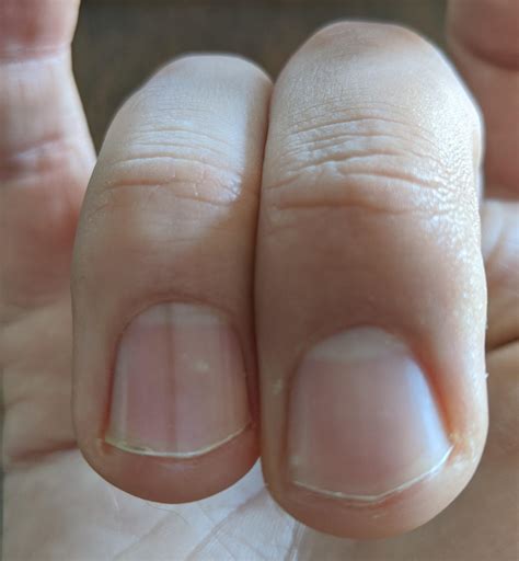 Albums 103+ Pictures Photos Of Toe Nail Melanoma Updated