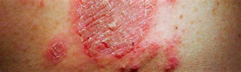 What Causes Body Rash In - vrogue.co