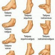 acquired equinus foot deformity - Bing images | Pediatric physical therapy, Medical anatomy ...