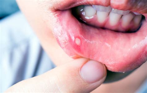 Canker Sores: Causes, Symptoms and Treatments - Platinum Dental Surgery
