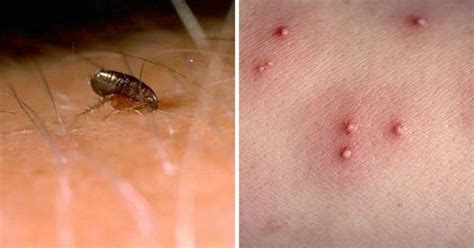 How To Recognize Each One Of These 12 Common Bug Bites | Bug bites, Spider bites