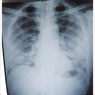 (PDF) Chest X-rays findings in COVID 19 patients at a University Teaching Hospital - A ...