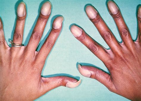 Ногти Гиппократа или симптом барабанных палочек – причины, лечение и профилактика