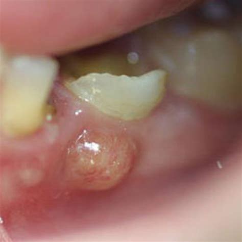 how to drain your own tooth abscess - Money Blogged Photogallery