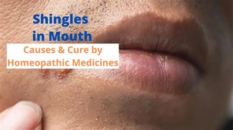 Shingles in Mouth– Symptoms, Causes & Homeopathic Medicines