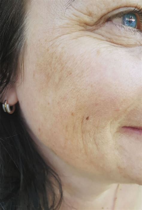 Will Melasma Go Away After Menopause? – the BEAUTIOUS