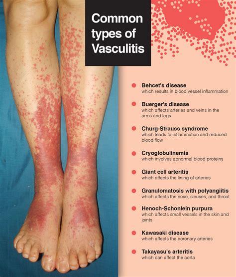 Autoimmune Vasculitis Types