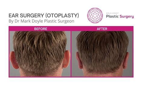 Otoplasty Before and After Photos Gold Coast | Gold Coast Plastic Surgery