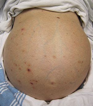 Abdominal distension - Wikipedia