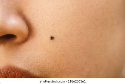 9,030 Face Mole Images, Stock Photos & Vectors | Shutterstock