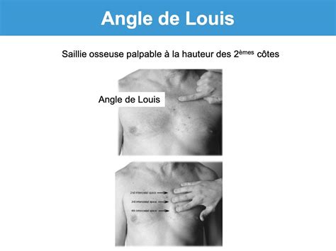 Angle de Louis : e-cardiogram