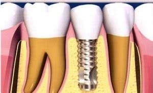 The Success Rates and Risks of Dental Implant Treatment