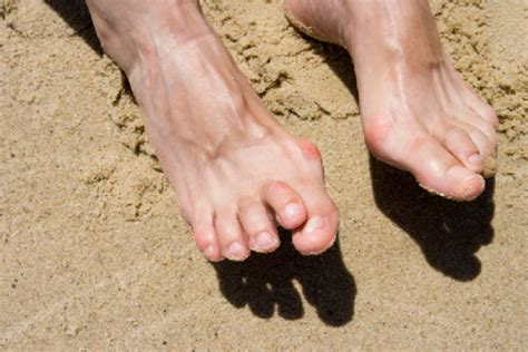 Overlapping Toes | Achilles Podiatry