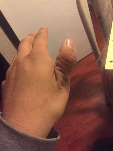 HORRIFYING PHOTOS: Teens Embark On Online Thumb Dislocation Challenge