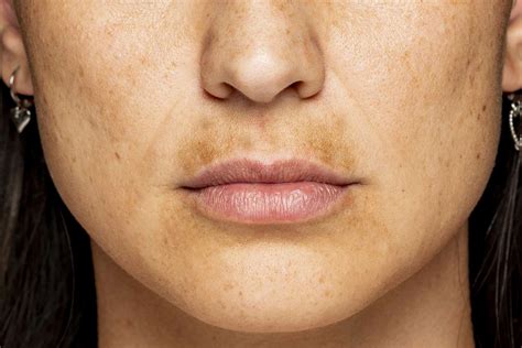 What Is a Melasma Mustache and How Do I Get Rid of It?