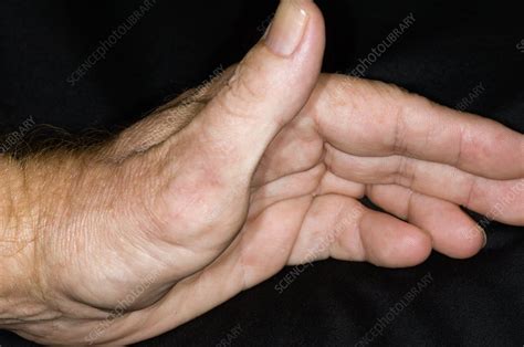 Thumb after surgery for dislocation - Stock Image - C006/9196 - Science ...