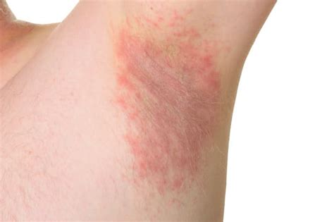 What are Common Symptoms and Treatments for Fungal Skin Infections?