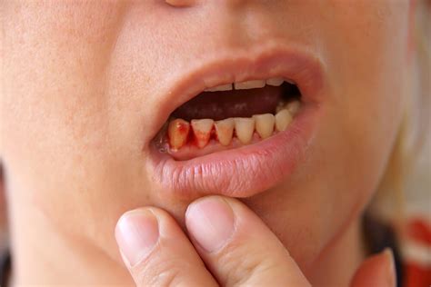 Bleeding Gums: Causes, Dos and Don'ts, And Treatment - fitness and health advisor