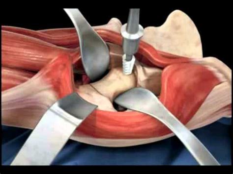 Arthroplasty Masterclass: Bipolar Hip Replacement | bipolar hemiarthroplasty หมาย ถึง - CASTU