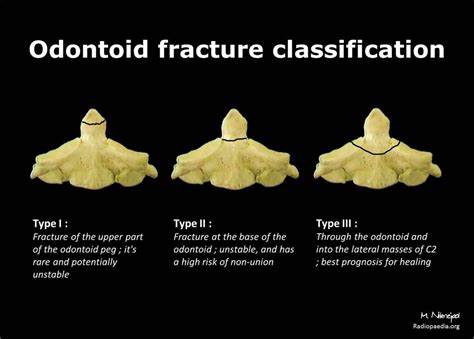 Odontoid fracture classification: diagram | Radiology Case | Radiopaedia.org | Radiology ...