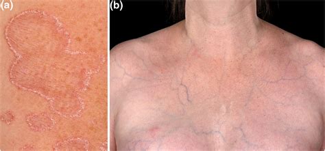 Vascular Ehlers Danlos Syndrome