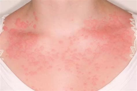 Chronic spontaneous urticaria: clinical features, diagnosis and ...