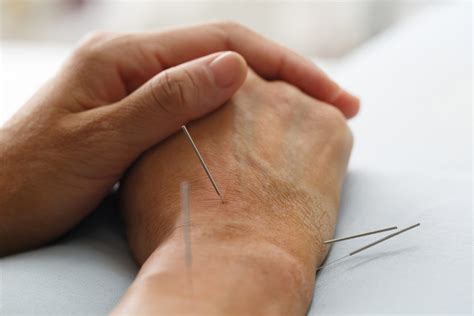 Have You Tried Acupuncture for Carpal Tunnel Syndrome?WholeSelf ...