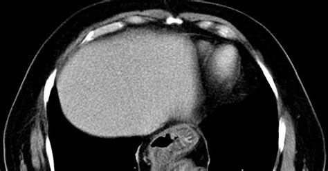 CT Scan Tips & Protocols: Hiatal Hernia in CT