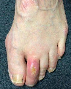 Hammer Toe Deformity | Toe Conditions | The London Foot & Ankle Clinic